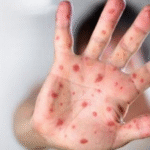 cocuklarda-el-ayak-agiz-hastaligi-kapak-43