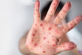 cocuklarda-el-ayak-agiz-hastaligi-kapak-43