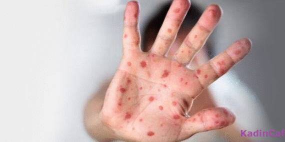 cocuklarda-el-ayak-agiz-hastaligi-kapak-43