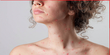 sucicegi-olan-kadin-emzirebilir-mi-k430