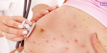 hamileyken-sucicegi-asisi-yaptirilir-mi-k34