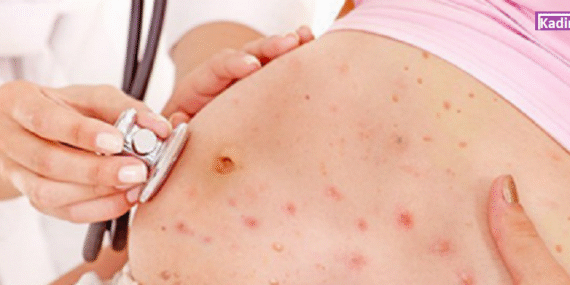 hamileyken-sucicegi-asisi-yaptirilir-mi-k34